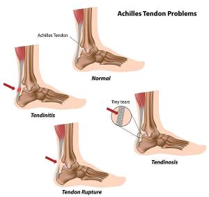 Achilles Tendinopathy