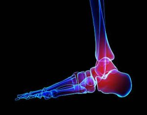 Pain in heel and achilles