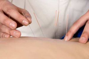 Acupuncture for back pain