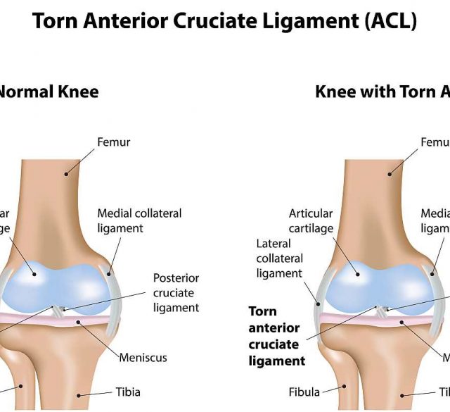 ACL Injury Faye Pattison Physiotherapy Chelmsford