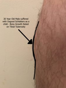 Osgood Schlatters disease bony growth on knee