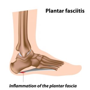 Inflamed plantar fascia