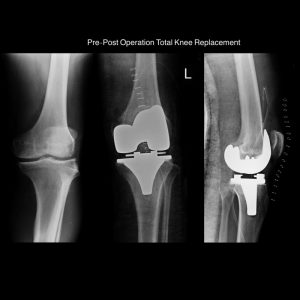 Total knee replacement post op due to arthritis