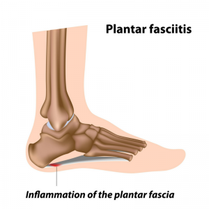 Inflamed Plantar Fascia