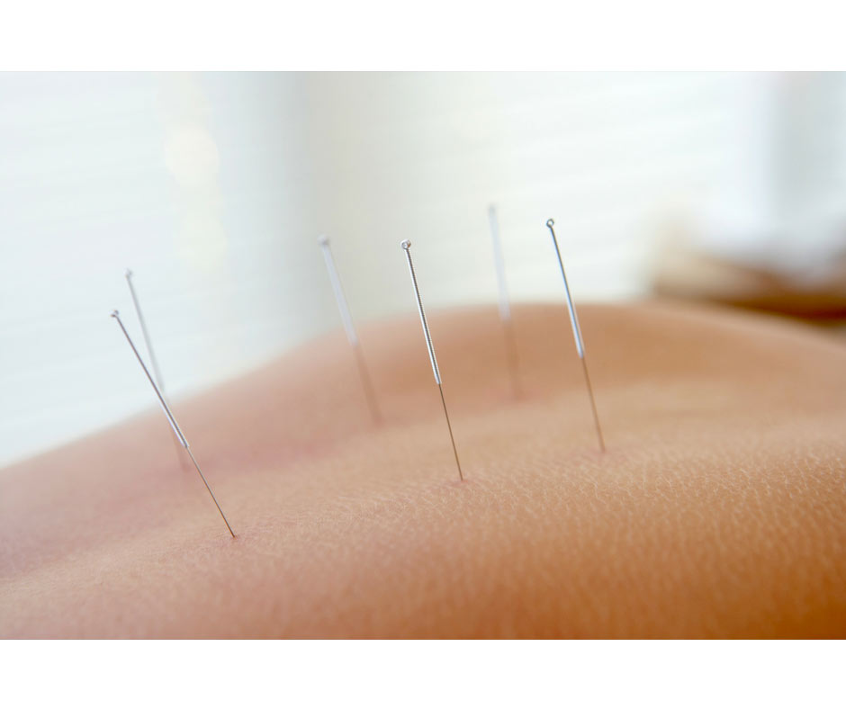 Acupuncture Chelmsford back pain releif
